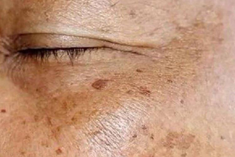 脂溢性角化病眼周斑图