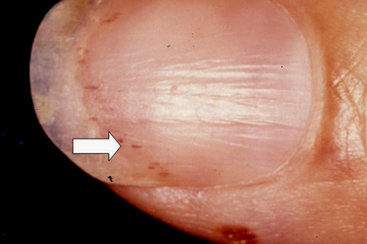甲裂隙状出血图