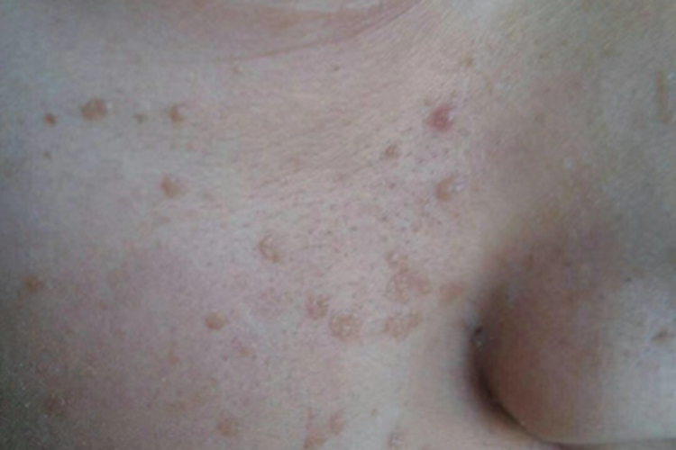 扁平疣脸上有浅褐色小疙瘩图 扁平疣脸上有浅褐色小疙瘩图