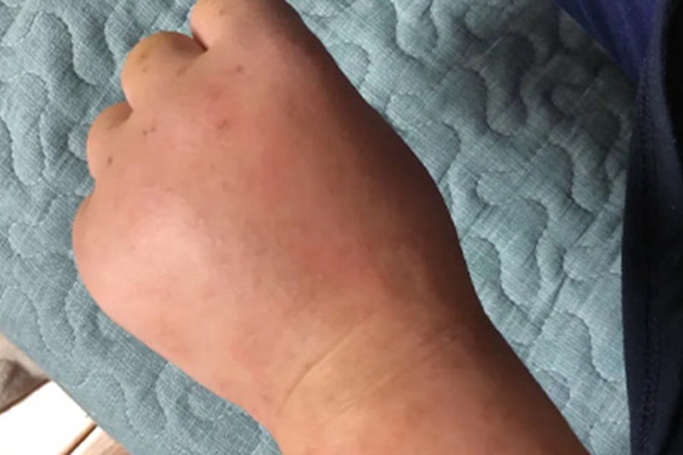 妊娠多形疹手背症状图 妊娠多形疹手背症状图