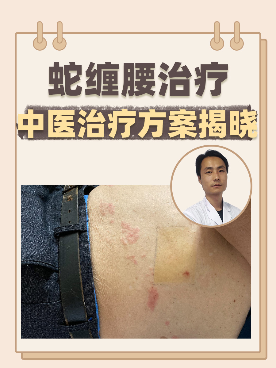 蛇缠腰治疗：中医治疗方案揭晓