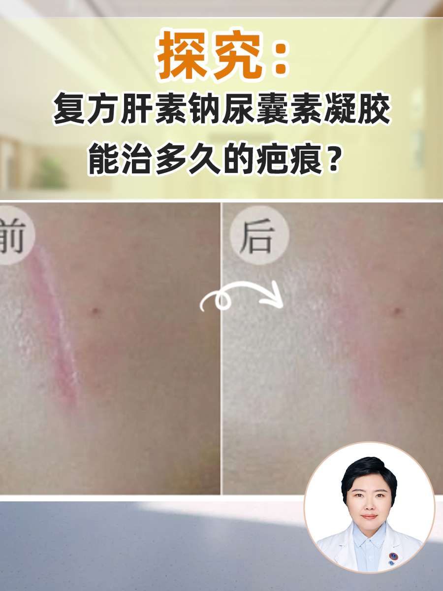 探究：复方肝素钠尿囊素凝胶能治多久的疤痕？