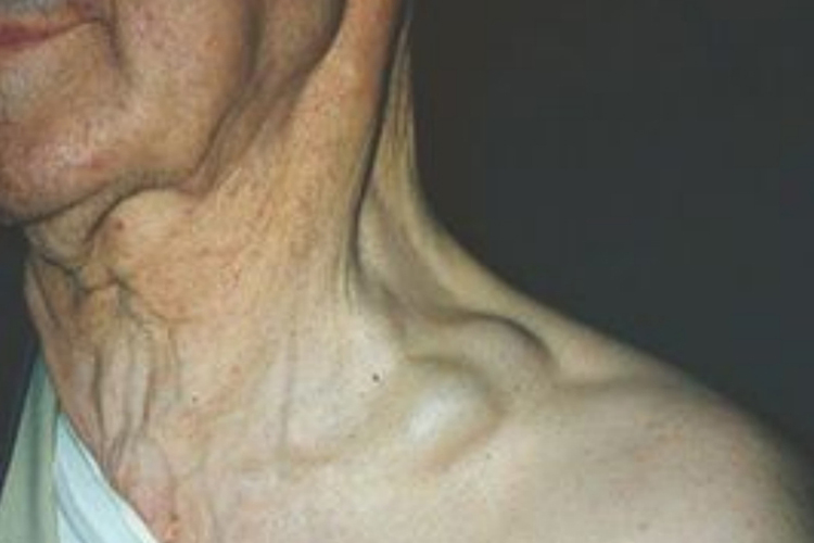 颈部淋巴结肿大图