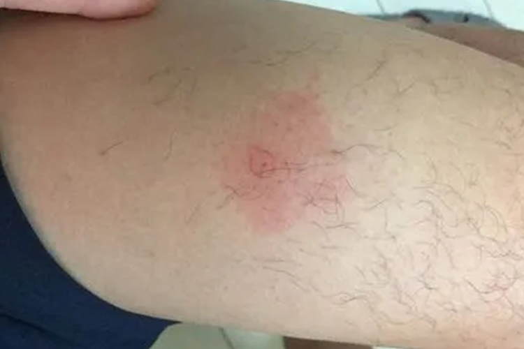 蜂蛰伤红肿图大腿被蜂子蜇后局部立即出现明显疼痛,烧灼感及痒感,很快