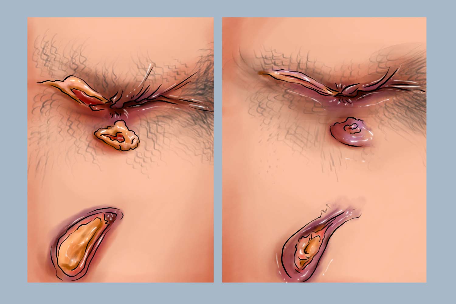 肛瘘术后爬皮图 肛瘘术后爬皮图