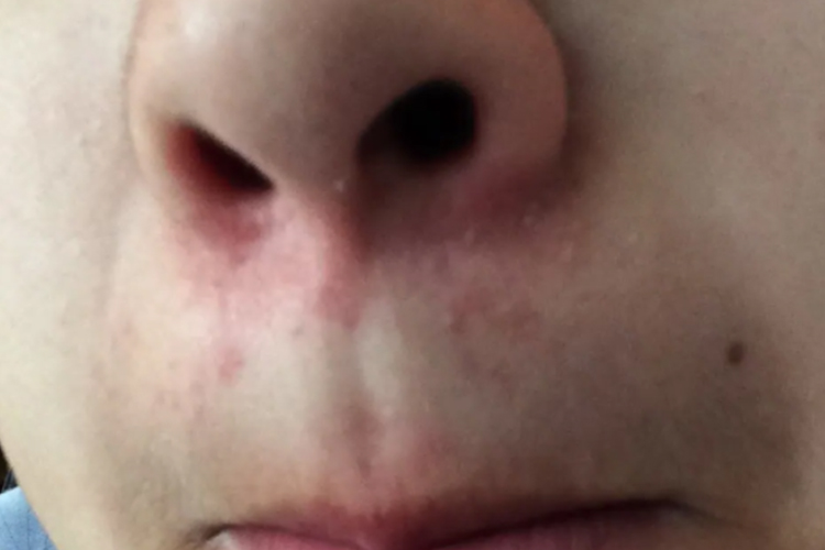脂溢性皮炎鼻子下方红红的图 脂溢性皮炎鼻子下方红红的图