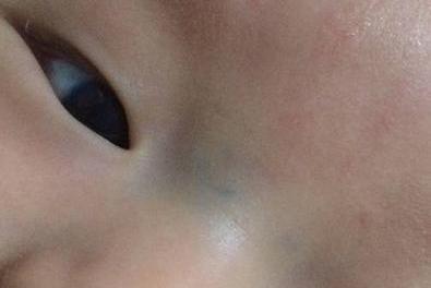 宝宝先天性心脏病眉心发青图