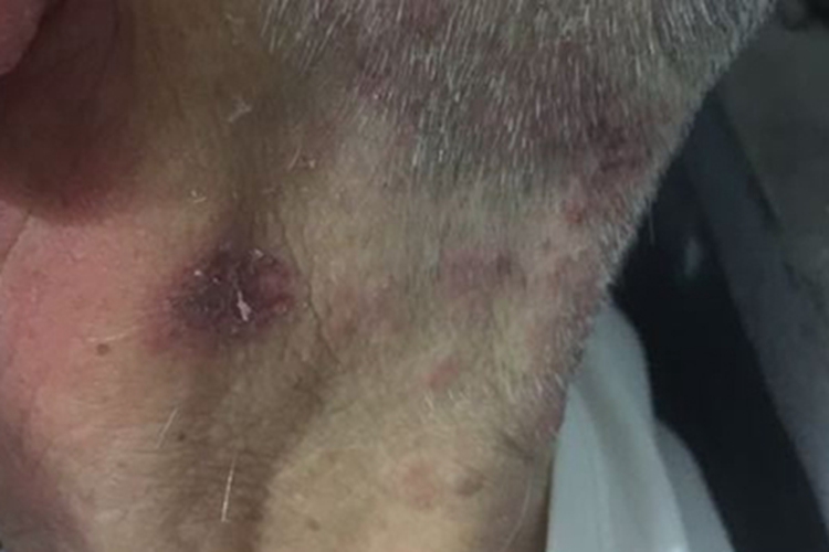 成人脂溢性皮炎后颈症状图