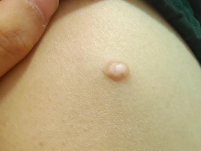 皮脂腺上皮瘤腹部皮色结节图