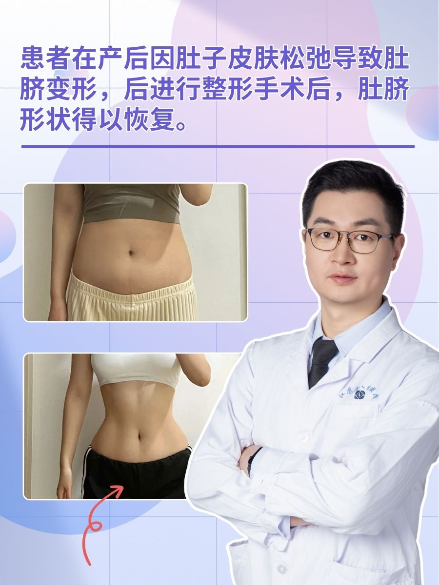 重塑脐部美学：医生解答肚脐整形手术全过程