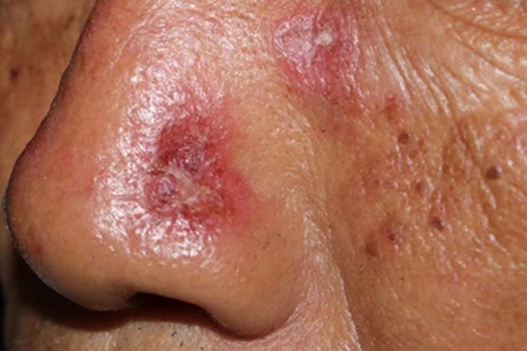 老年性角化病鼻部结痂图