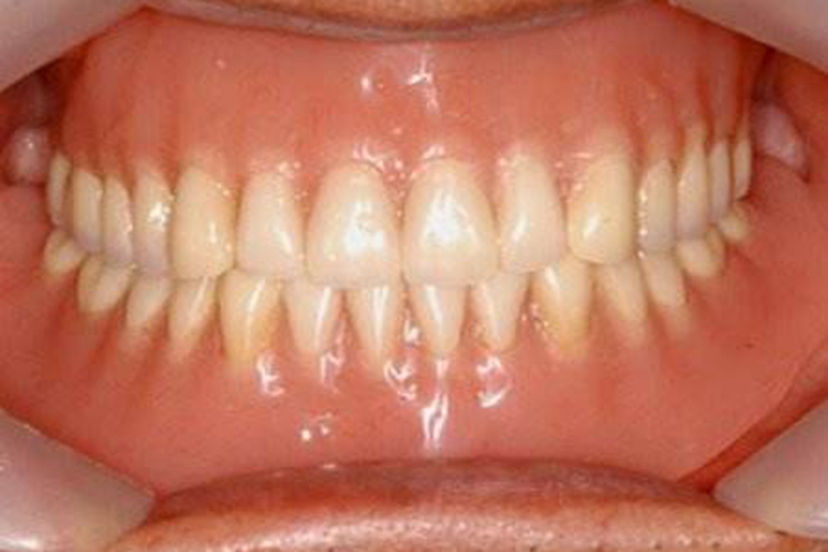 牙槽骨肉眼观图