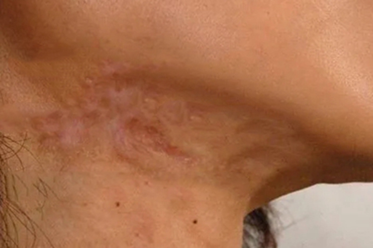 球孢子菌病留有瘢痕图