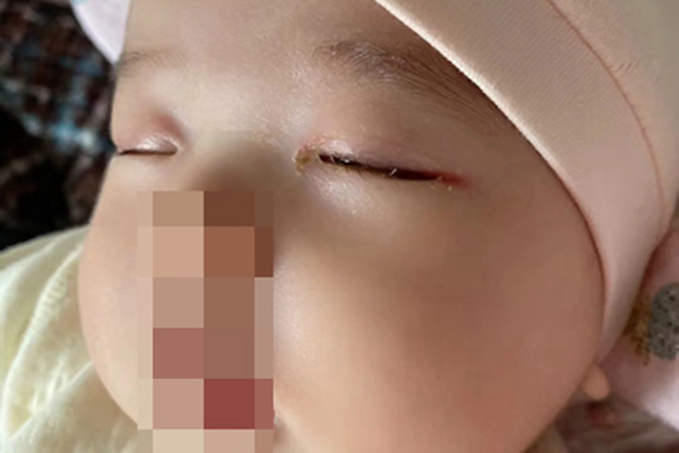 新生儿结膜炎眼部症状图