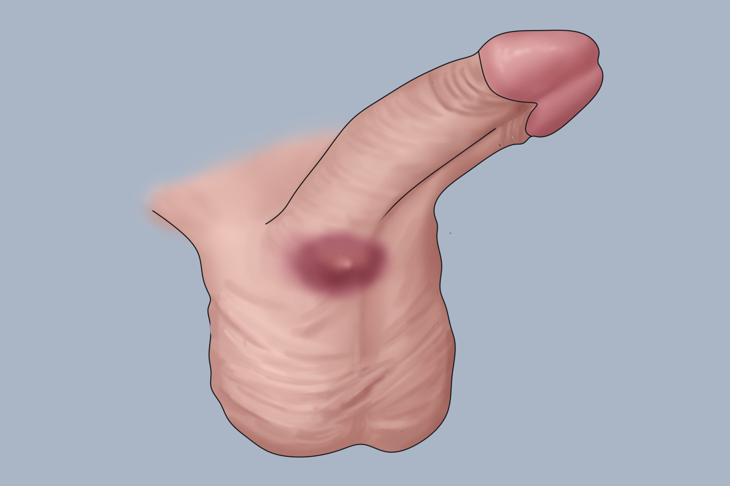 阴茎根部粉瘤手绘图