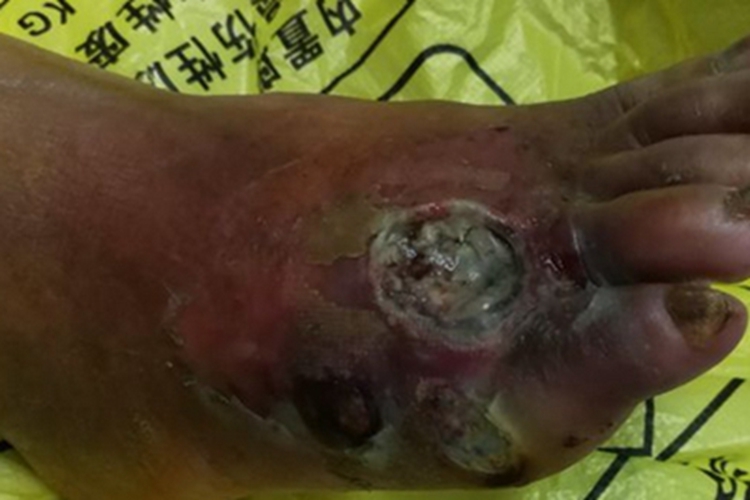 Ⅲ级糖尿病足症状图