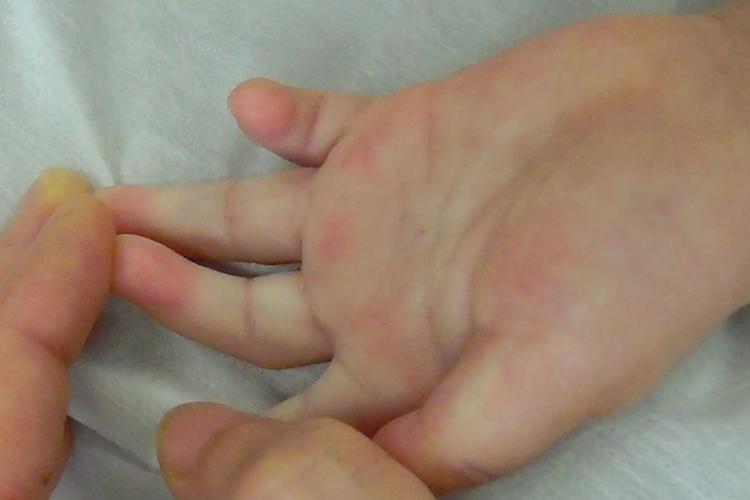 婴儿先天性小指弯曲图