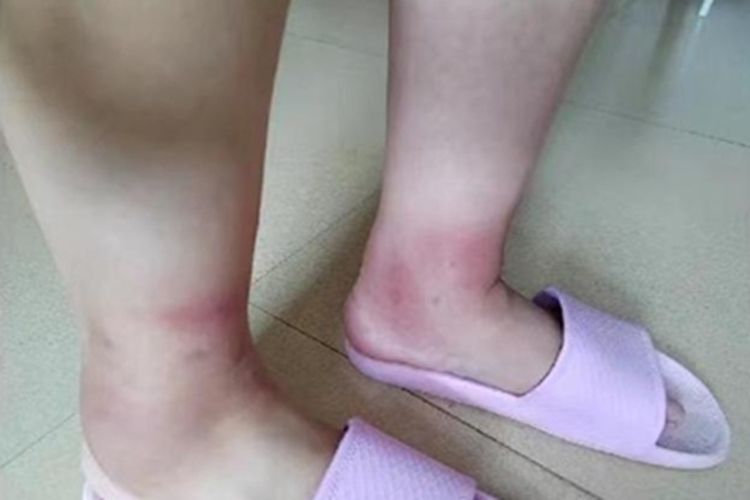 蚊虫叮咬脚踝处红肿图 蚊虫叮咬脚踝处红肿图