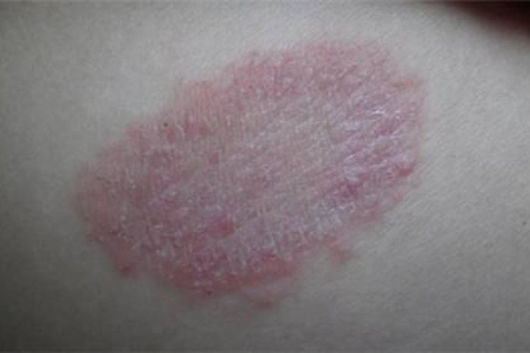 体癣红斑丘疹图