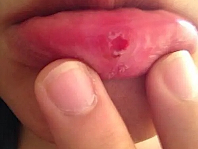 一期口腔梅毒下嘴唇里面烂了一块图.jpeg