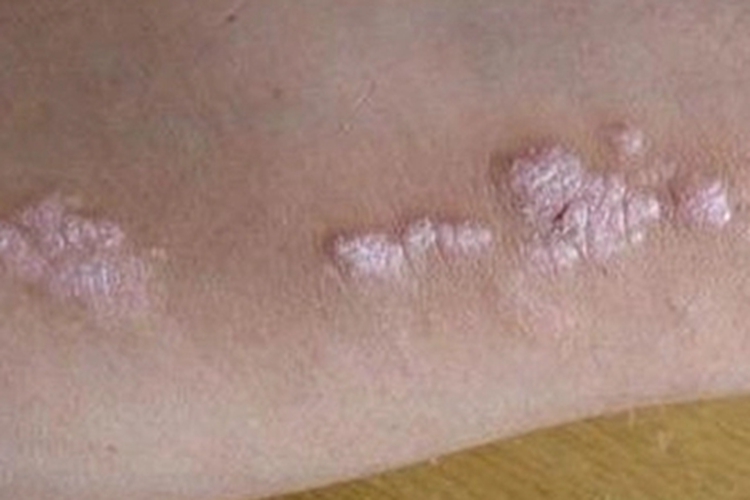 扁平苔藓样角化病胳膊症状图 扁平苔藓样角化病胳膊症状图