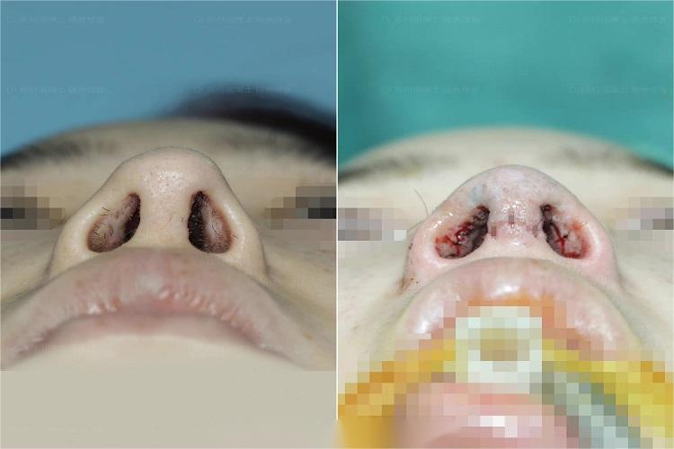 鼻尖软组织削减修整手术图