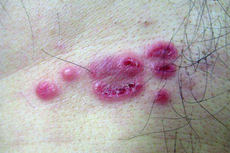 白血病特异性皮损图 白血病特异性皮损图