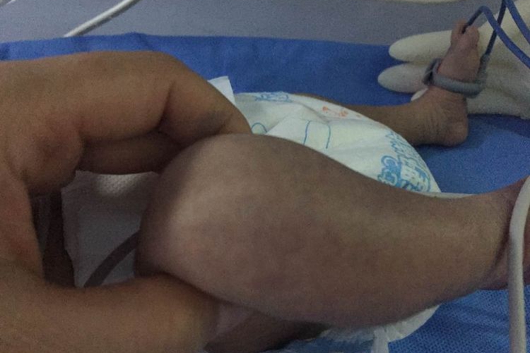 新生儿硬肿症下肢症状图