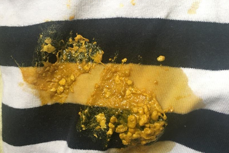 水便分离样大便图