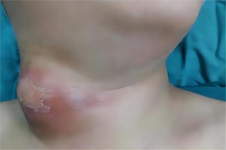 宝宝脖子表皮样囊肿图