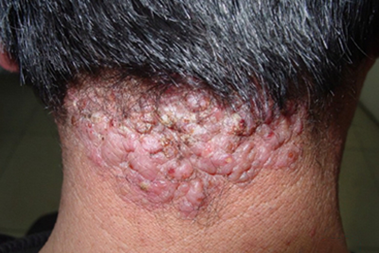 秃发性毛囊炎后颈症状图 秃发性毛囊炎后颈症状图