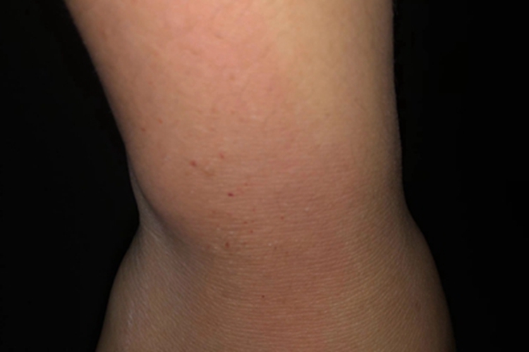 光毒性接触性皮炎血点图