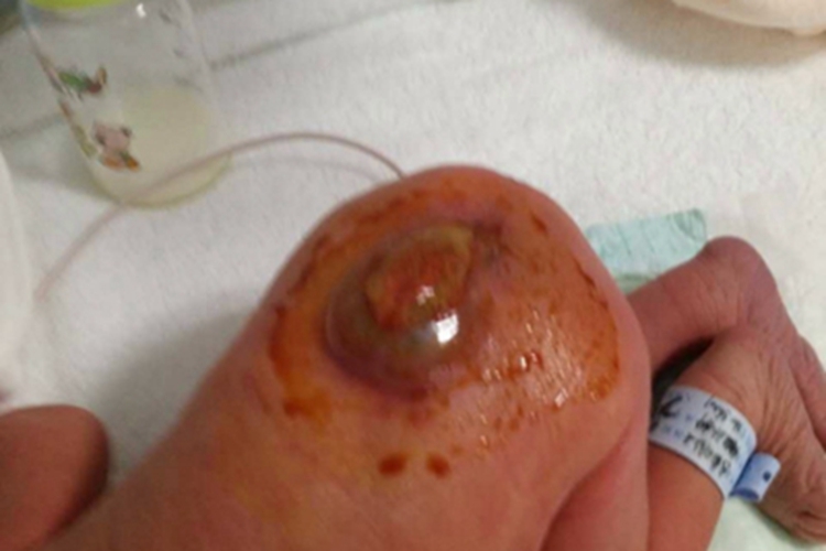 囊性脊柱裂症状图