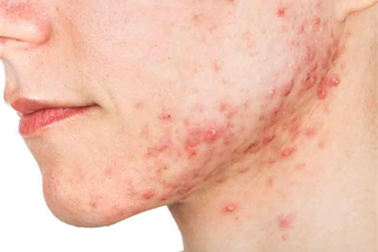 痤疮下巴丘疹图