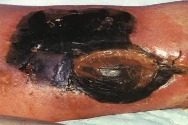 气性坏疽小腿皮肤发黑图