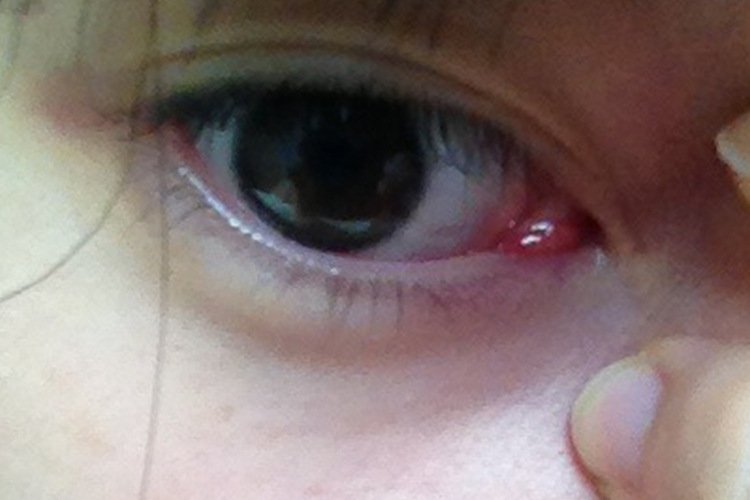结膜炎内眼角发炎红肿图