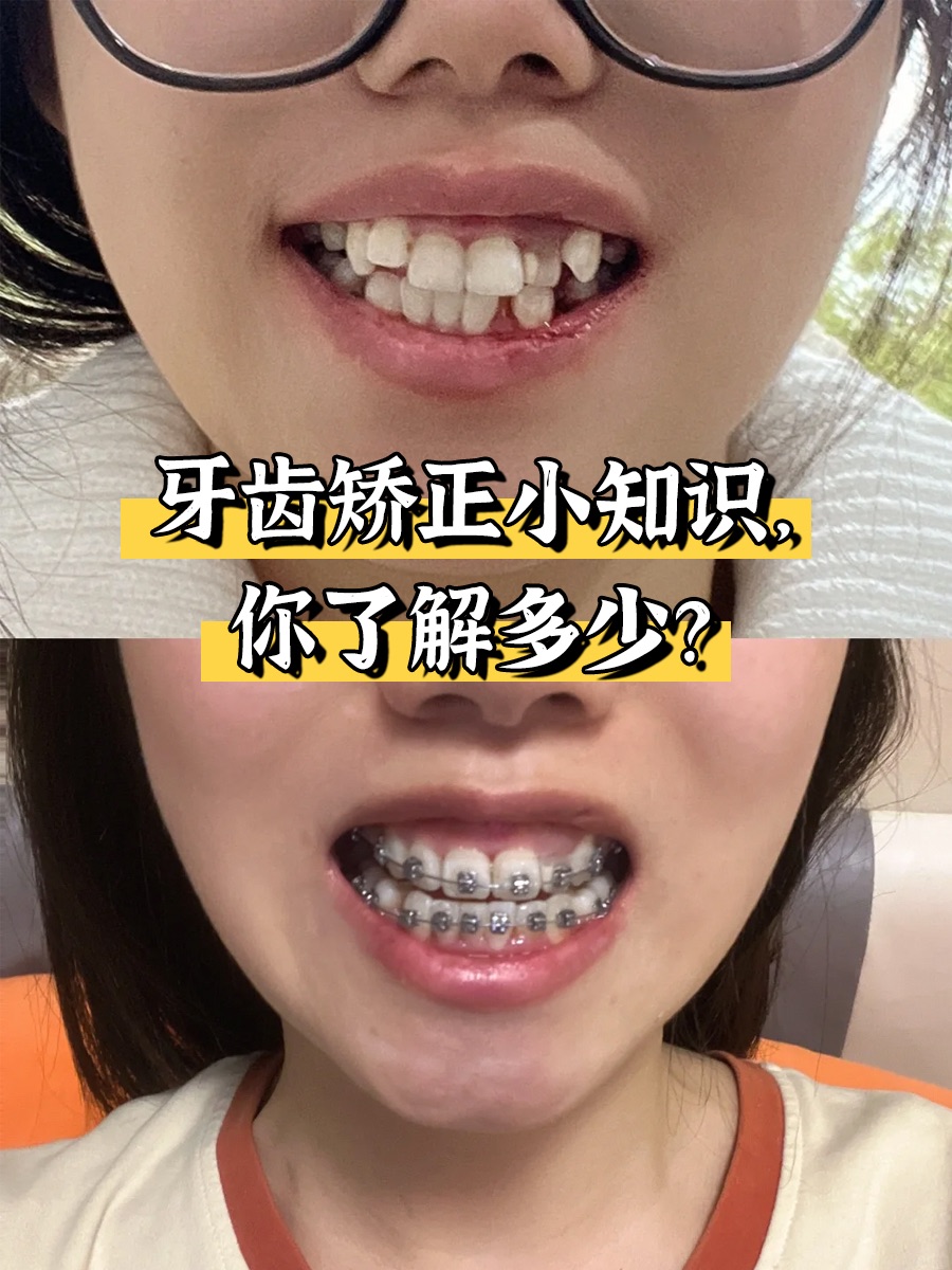 牙齿矫正小知识，你了解多少？