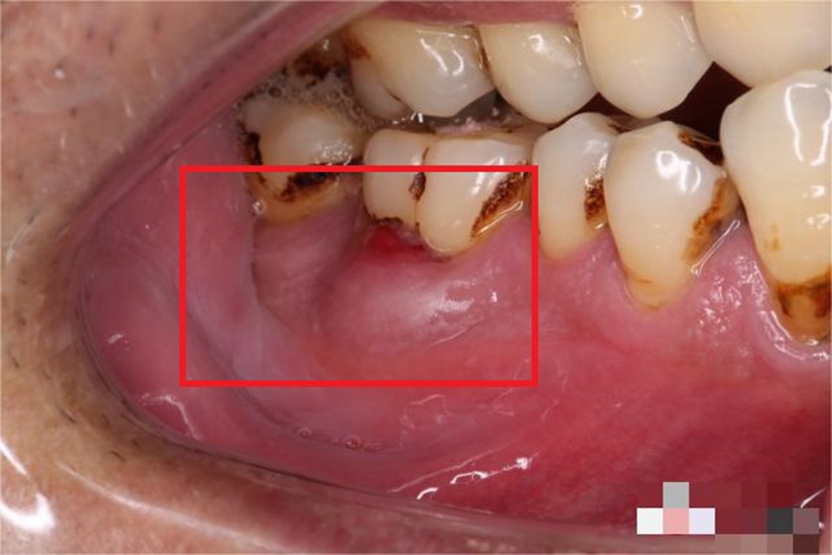 急性牙周脓肿牙龈肿块图 急性牙周脓肿牙龈肿块图