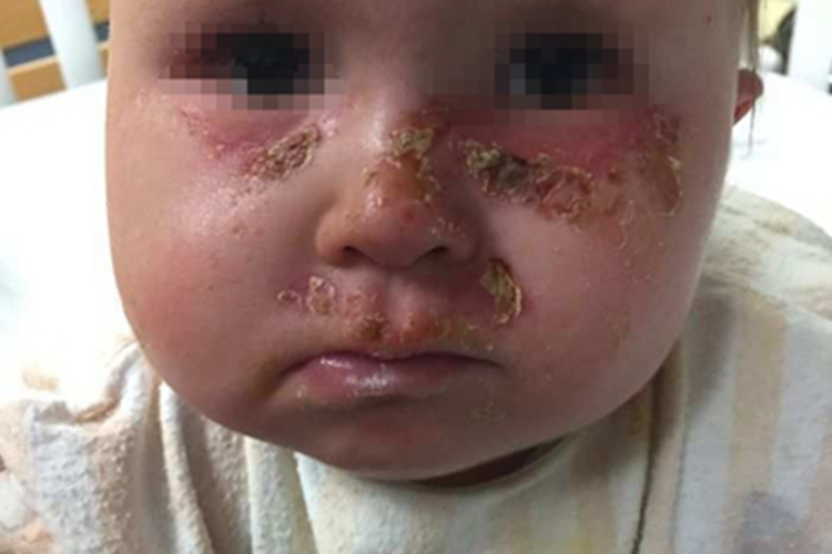 红细胞生成性原卟啉病面部红斑图 红细胞生成性原卟啉病面部红斑图