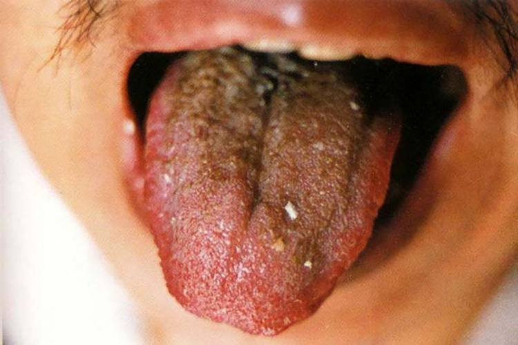 灰黑苔图 灰黑苔图