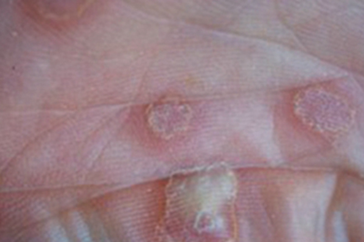 女性二期梅毒脓包图 女性二期梅毒脓包图