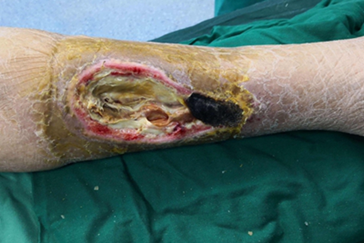 坏死性筋膜炎小腿症状图 坏死性筋膜炎小腿症状图