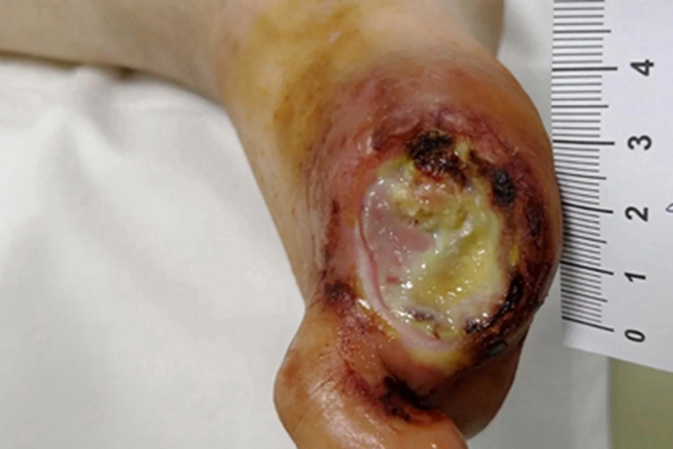 脂质渐进性坏死脚趾溃疡图