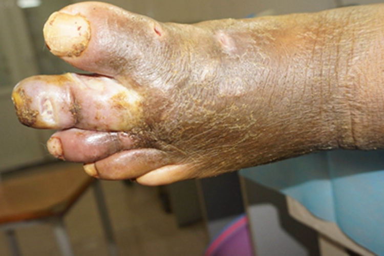 Ⅲ级糖尿病足脚部皮肤发黑图 Ⅲ级糖尿病足脚部皮肤发黑图