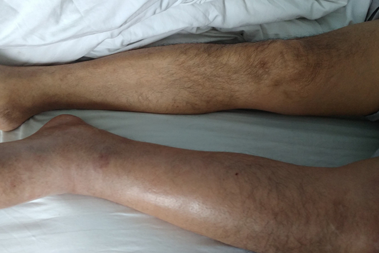 硬皮病水肿期图 硬皮病水肿期图