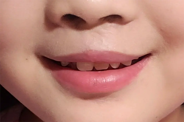 轻微唇裂修复术后图 轻微唇裂修复术后图