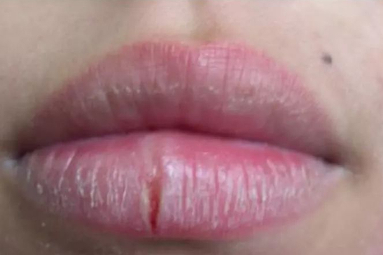 糜烂型念珠菌性唇炎