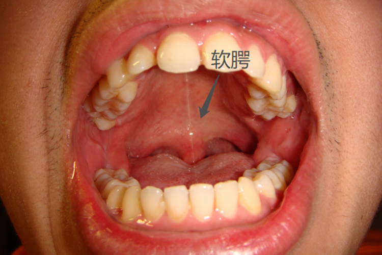正常人软腭图