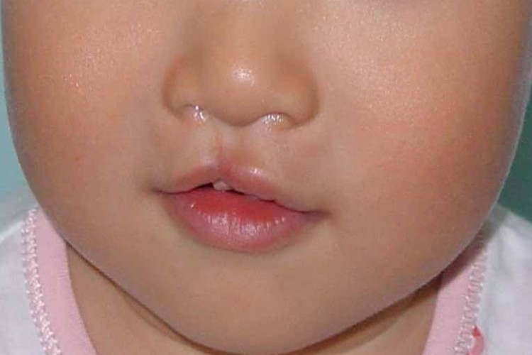 一度唇裂修复成功图