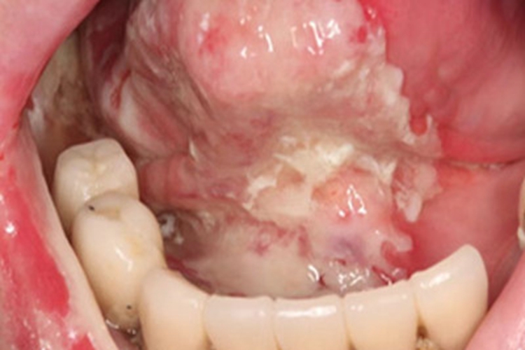 牙龈癌牙龈白斑图